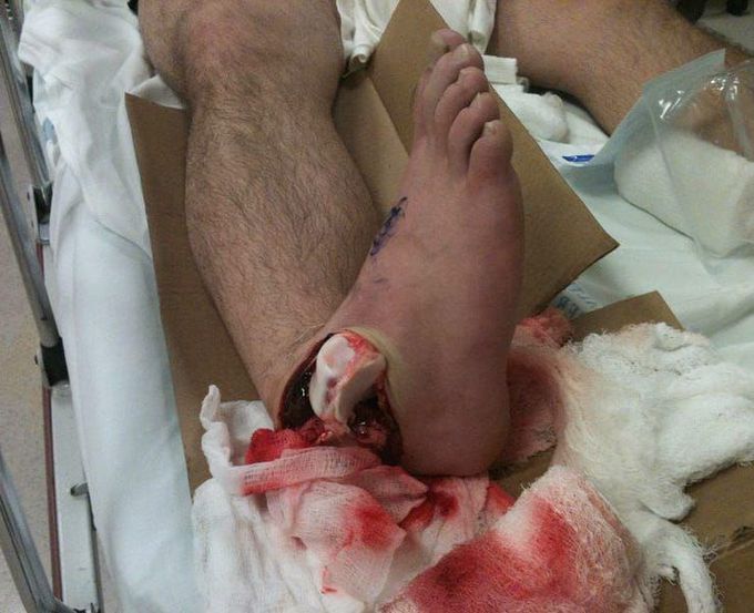 A horrible case of an open ankle dislocation!