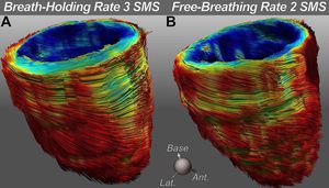 This is the first demonstration of whole heart DTI producing - MEDizzy