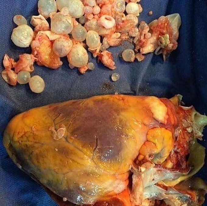 CARDIAC HYDATID CYST