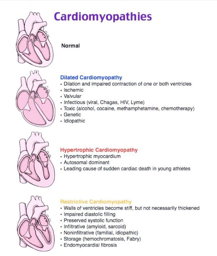 Cardiomyopathy - MEDizzy