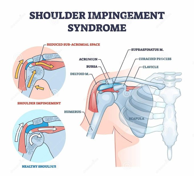 Shoulder Impingement Syndrome