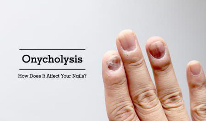 onycholysis