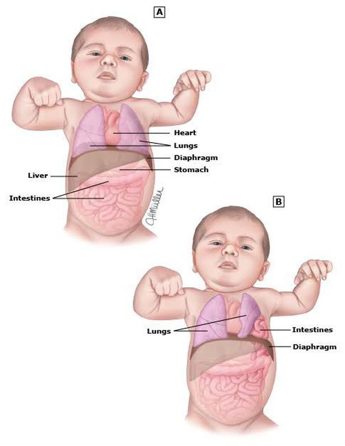 Congenital Diphragmatic Hernia