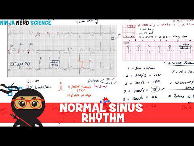 Normal sinus rhythm