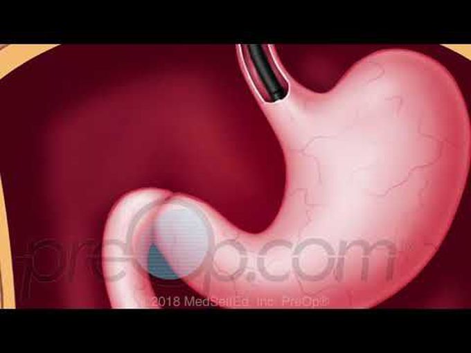 Upper GI
Endoscopy -
Animation