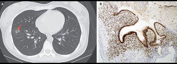 Thoracic Endometriosis