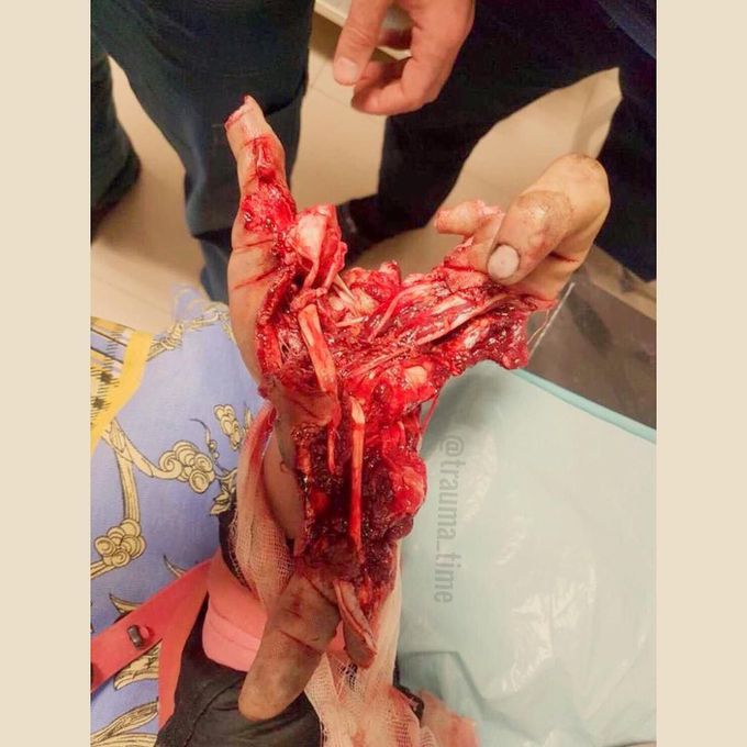 Firework hand trauma
