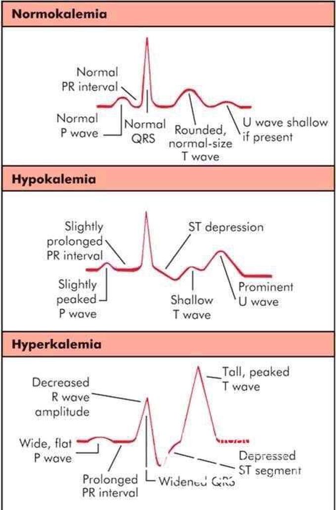 Hyperkalemia Ecg MEDizzy