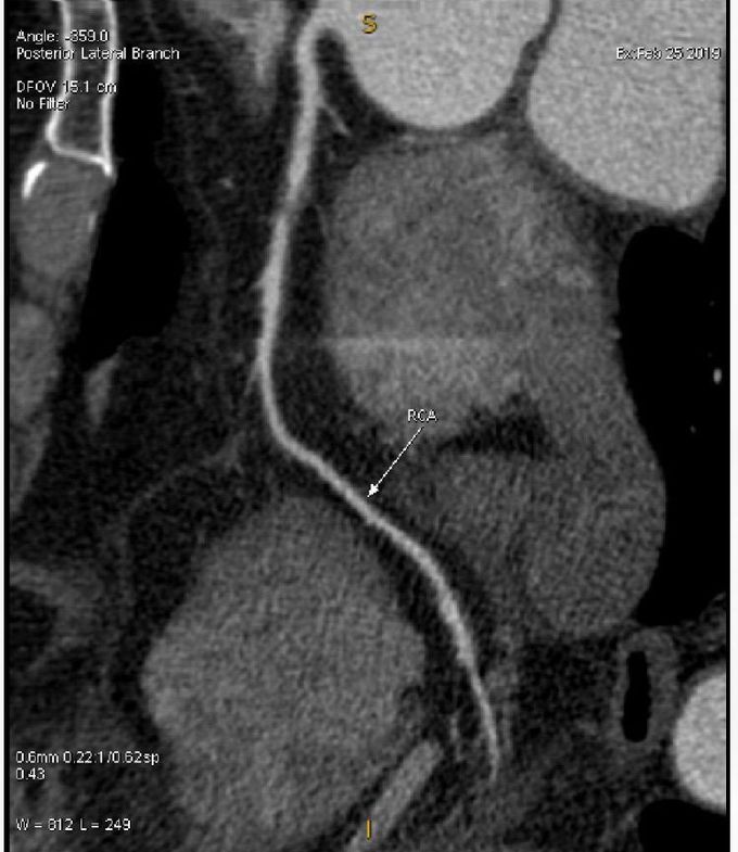 Angiogram of MI patient after EECP treatment