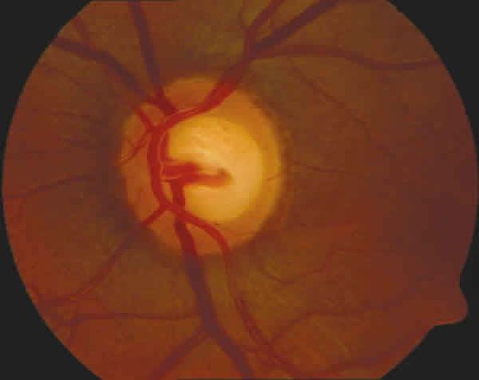Glaucoma