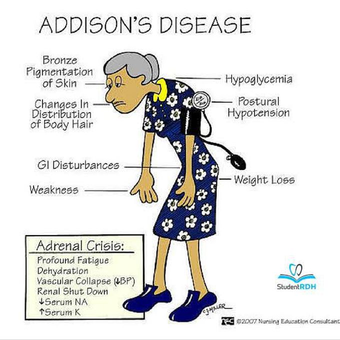 Addison's Disease Feature
