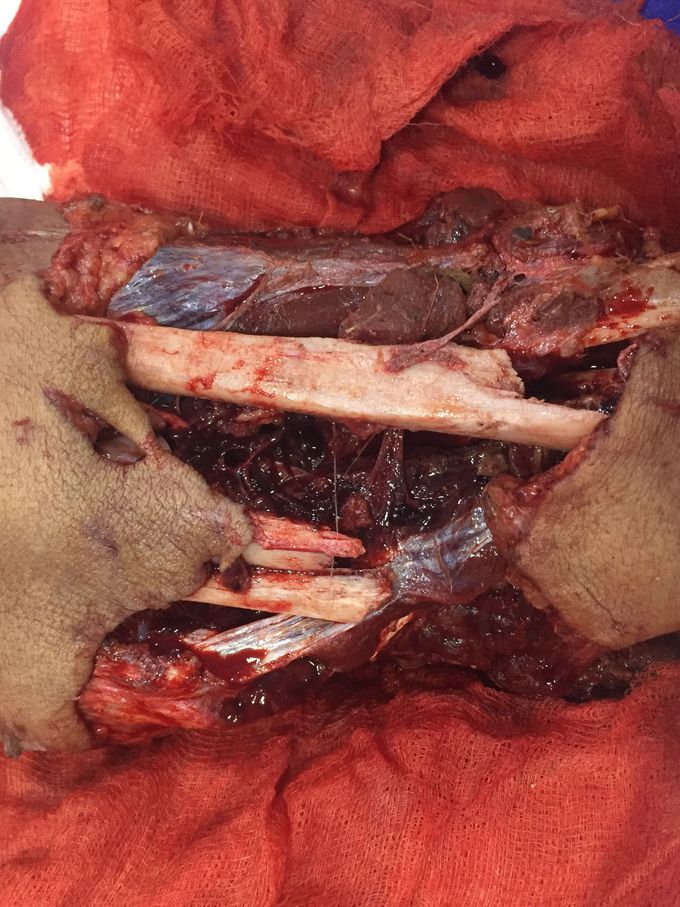 Open bone fracture (tibia)