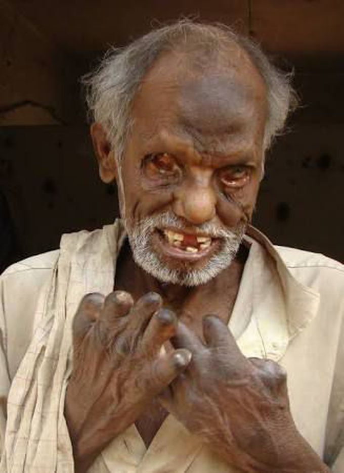 Leprosy