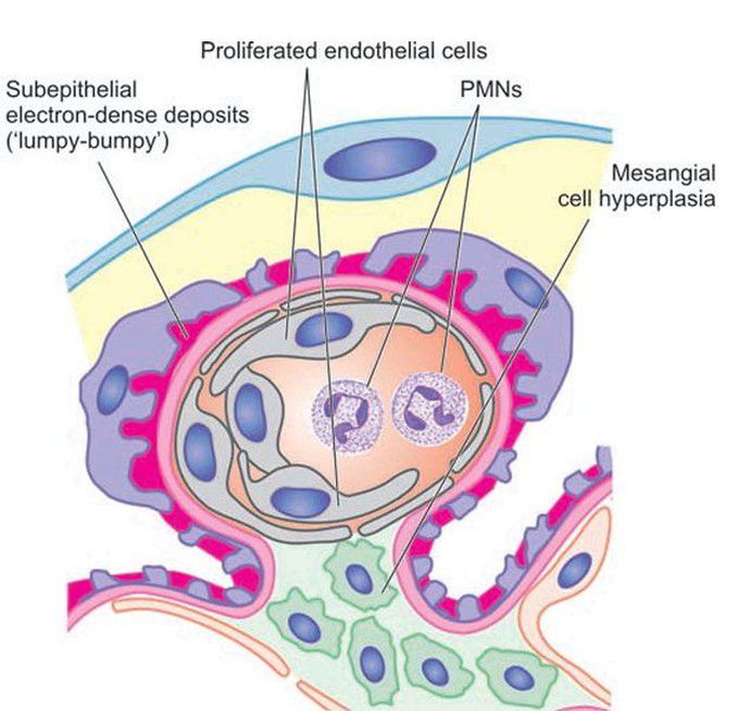 Acute glomerulonephritis