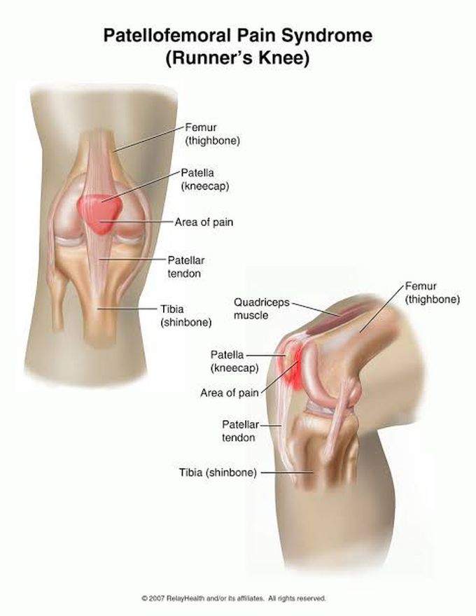 Patellofemoral Syndrome