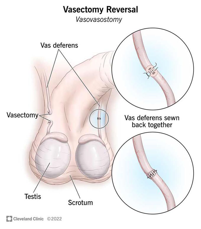 Risks in vasectomy