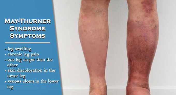 These are the symptoms of May thurner syndrome