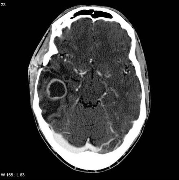 Ring Enhancing Lesion - Brain Abscess!