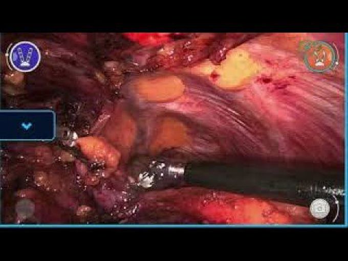 The World's First Versius Robotic Lobectomy - By Dr Sven Seifert, Chemitz, Germany