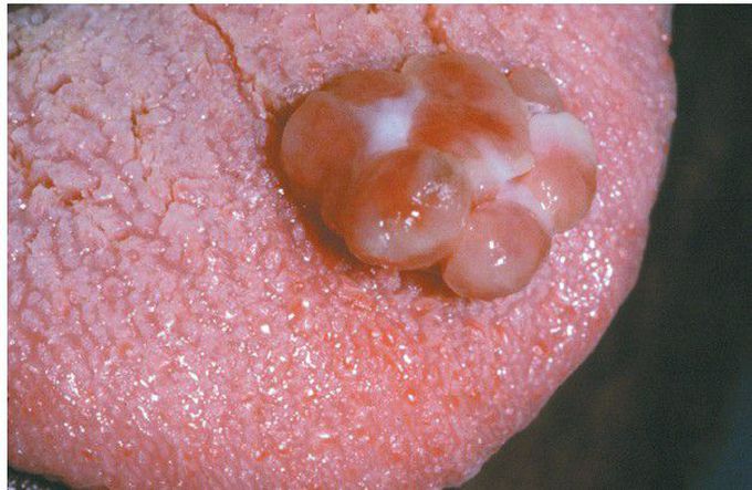 Pyogenic Granuloma