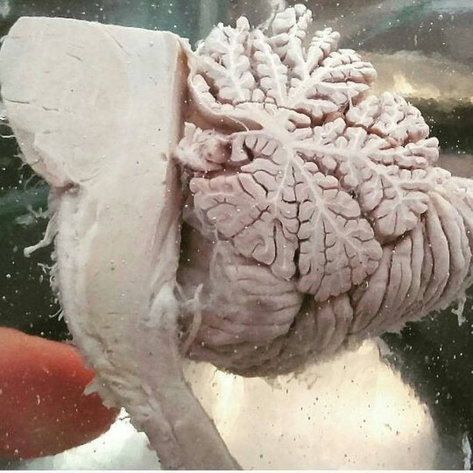 Cerebellum damage