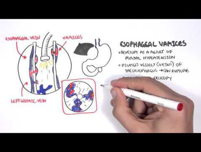 GI bleeding-Upper bleeding