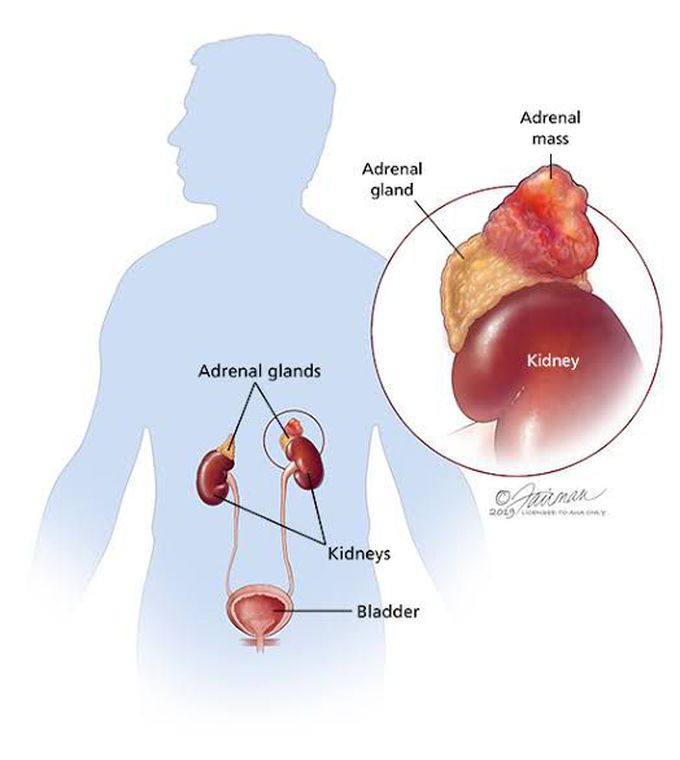 Pheochromocytoma