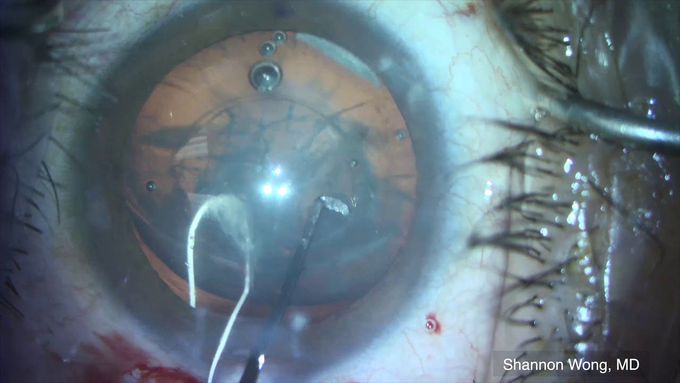 Ahmed Capsular Tension Segment - Cataract Surgery with loss of Zonules.  Shannon Wong, MD.