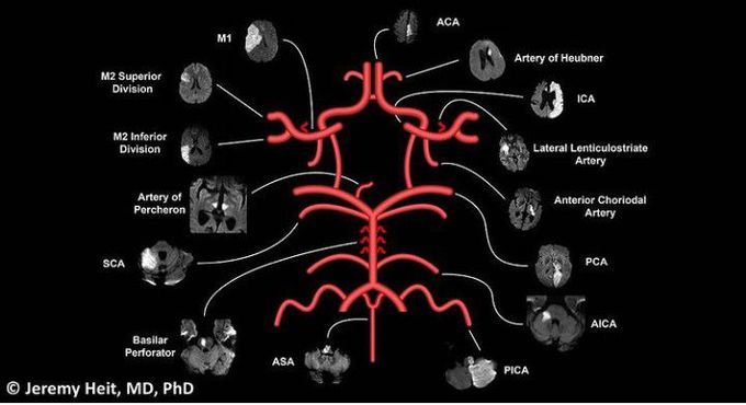 territories of brain stroke