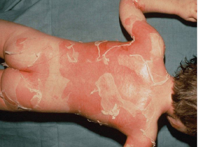 An infant presents to the hospital with the condition what is your diagnosis???