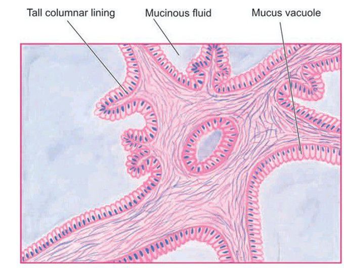 Mucinous cystadenoma of the ovary.