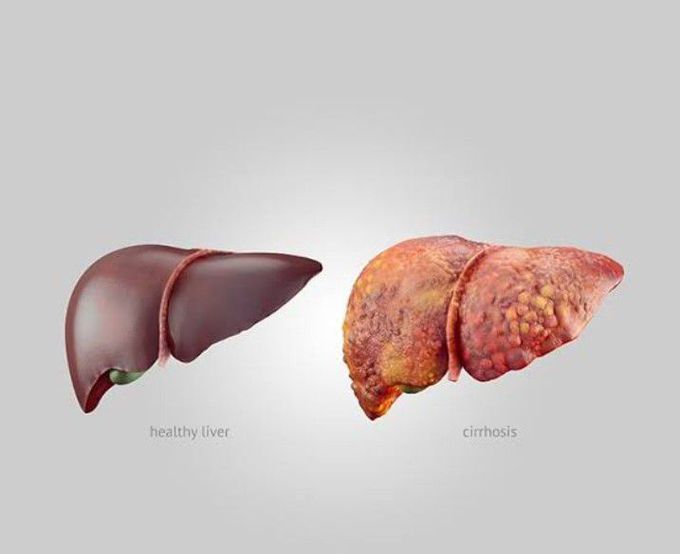 Cirrhosis of liver