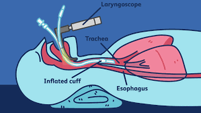 Intubation