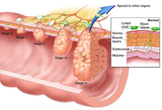 causes of esophageal cancer