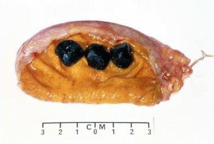 Pigment gallstones