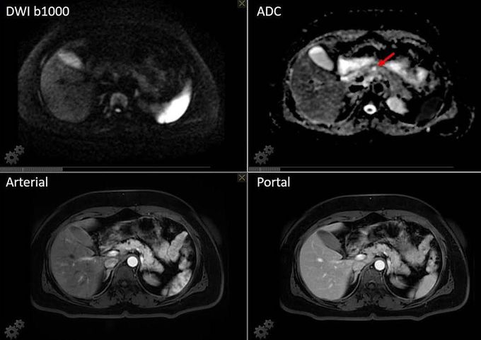 High-resolution MR Imaging of the pancreas