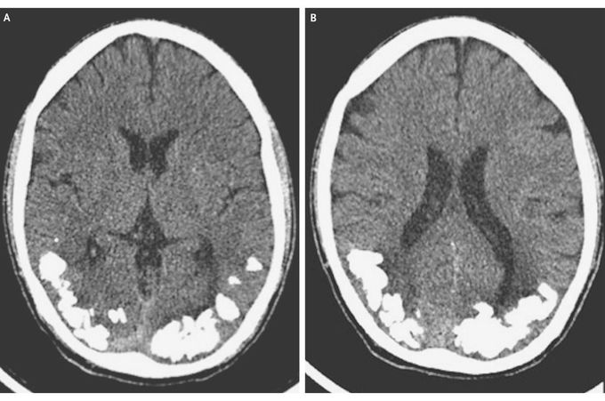 Occipital Calcification and Celiac Disease