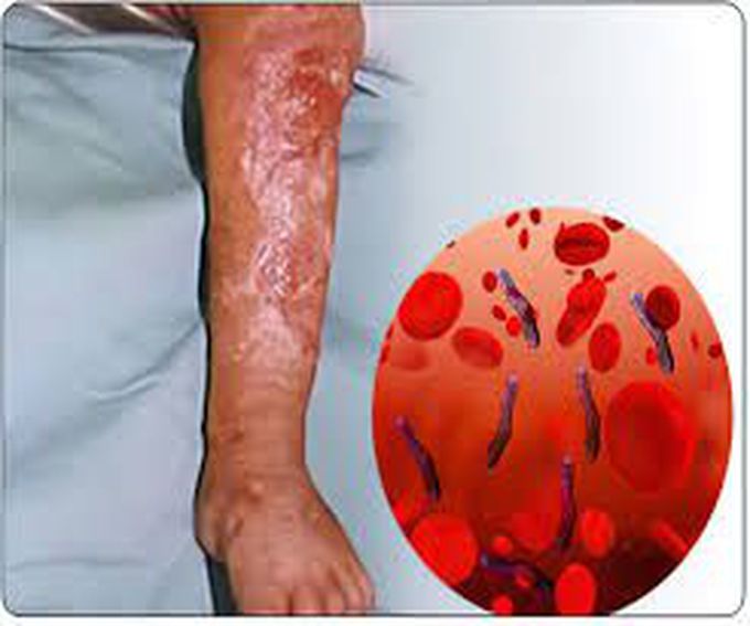 Treatment of septicemia