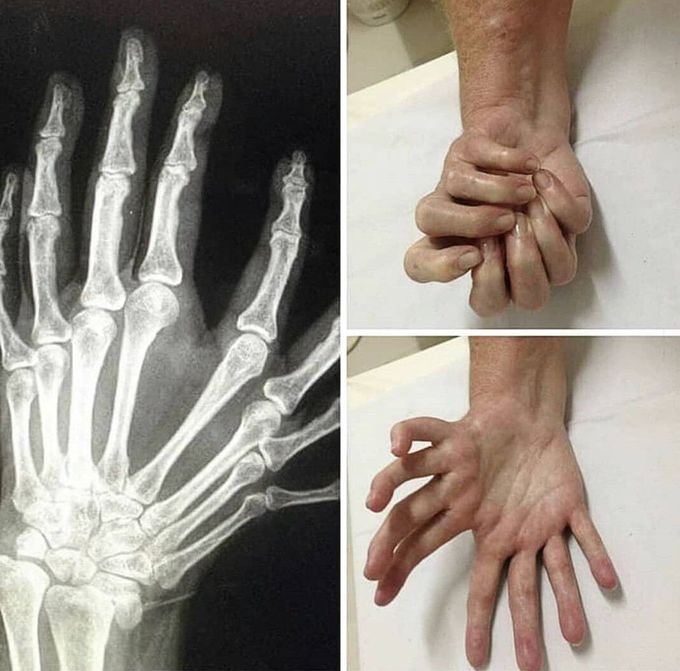 Mirror Hand Syndrome...