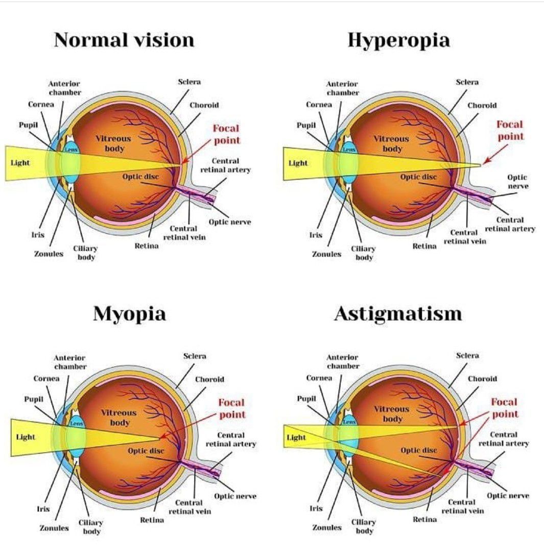 Haemolacria (Bloody Tears) - Anaheim Eye Institute