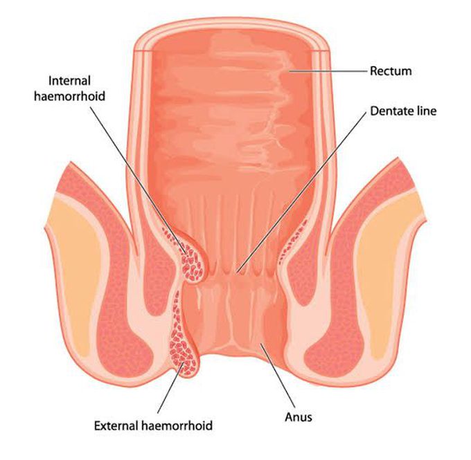Haemorrhoids