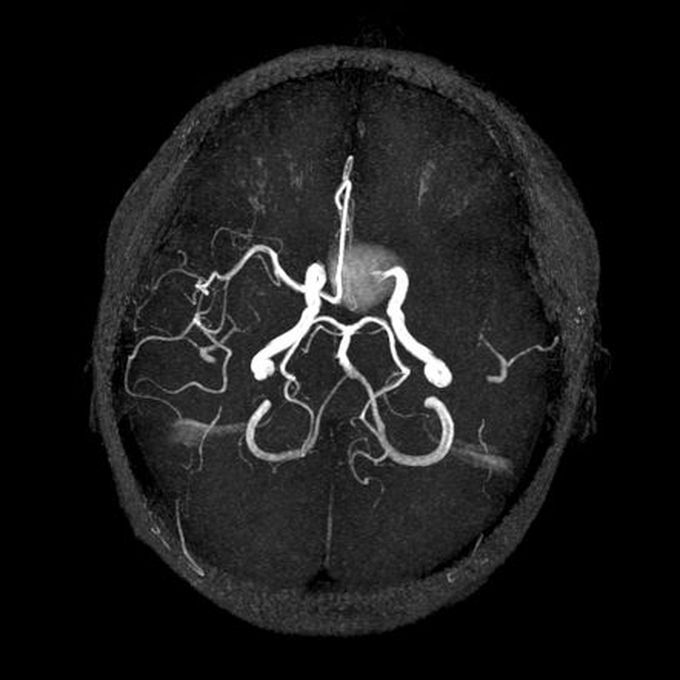 Most Common Cause of Subarachnoid Hemorrhage