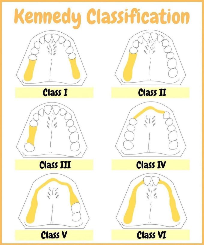 Kennedy classes