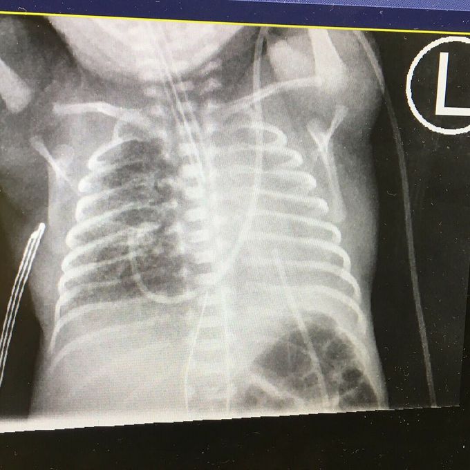 Cxray collapsed left lung