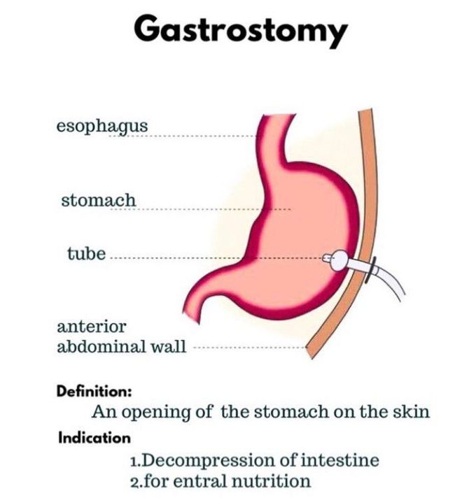 What is Gastrostomy?