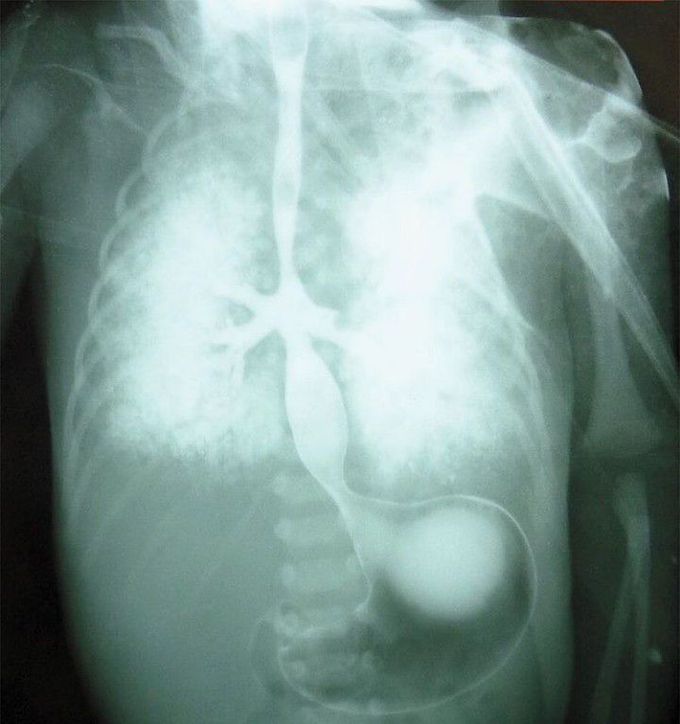 Tracheal Agenesis with Bronchoesophageal Fistula