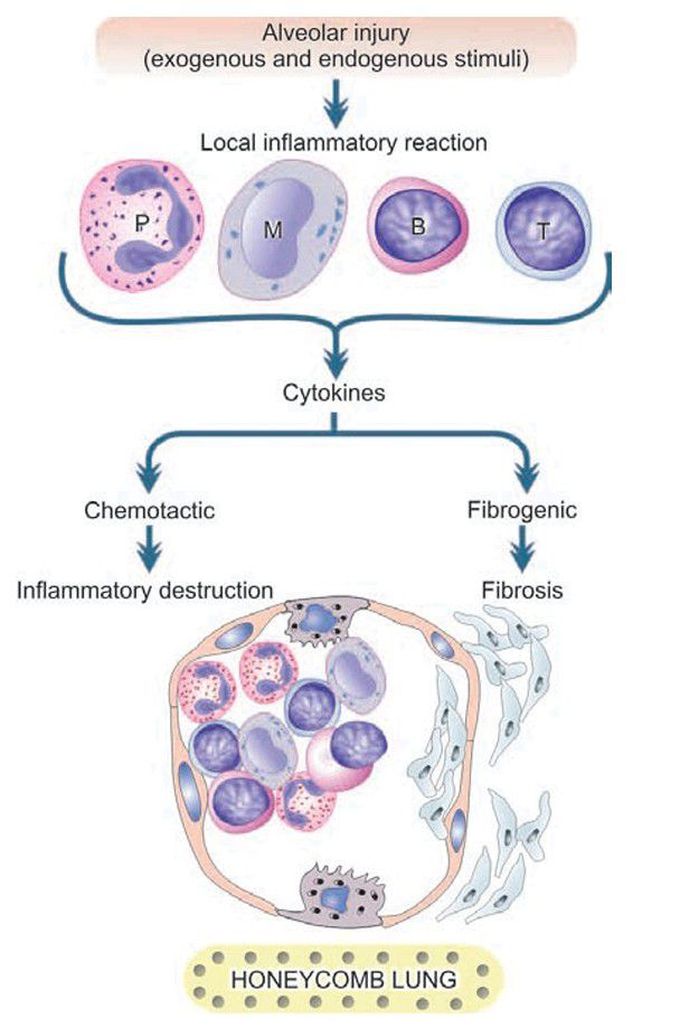 Interstitial lung disease (ILD).