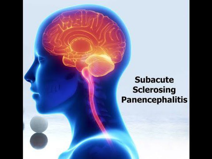 Overview of Subacute Sclerosing Panencephalitis (SSPE)
