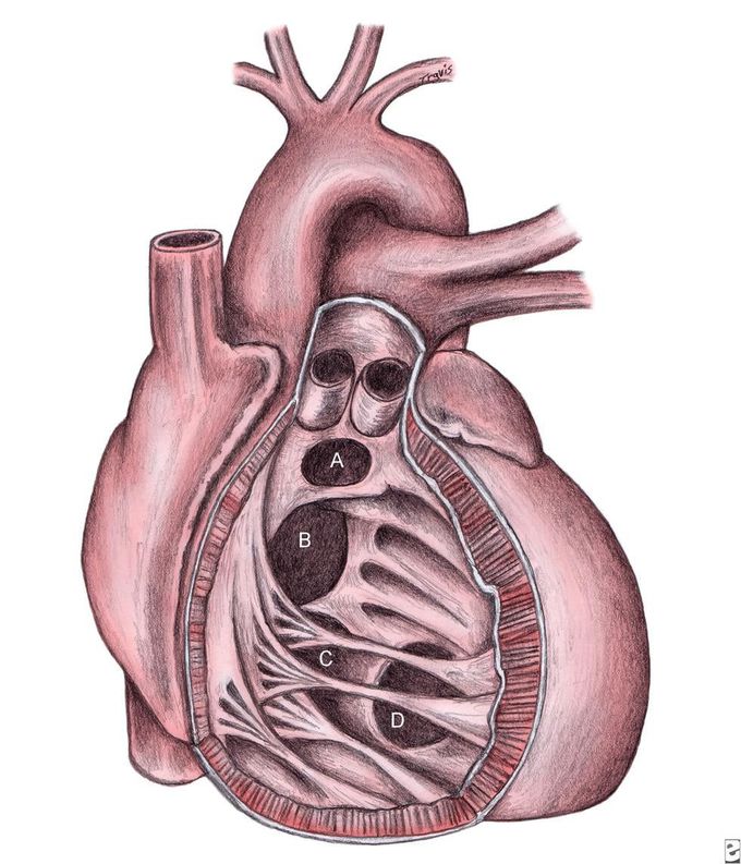 Classification of Ventricular Septal Defects (VSDs)