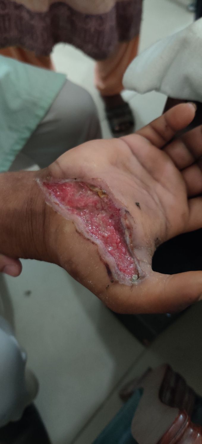 Non healing wound on hand